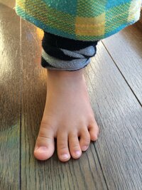 子供の内反小趾は直りますか もうすぐ2歳の子供の足です 月齢に沿って順調 Yahoo 知恵袋