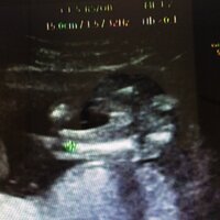 赤ちゃんの性別 17週の赤ちゃんのエコー画像です 先生はまだ性 Yahoo 知恵袋