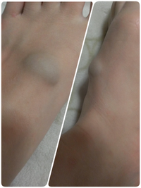 足の甲の血管が膨らんでいます 画像のようになっています いつから膨 Yahoo 知恵袋