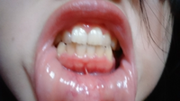 歯茎 から 歯 が 見える