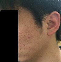 女性に質問です 彼氏がニキビ 跡 が多いと嫌ですか 好 Yahoo 知恵袋