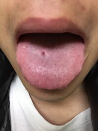 熱いご飯を食べて舌をやけどして二週間ぐらい治らないので見てみた Yahoo 知恵袋