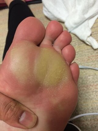 爪 足 臭い 親指 の