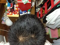高校二年生男子です つむじ付近から後頭部にかけて本以上白髪が生え Yahoo 知恵袋