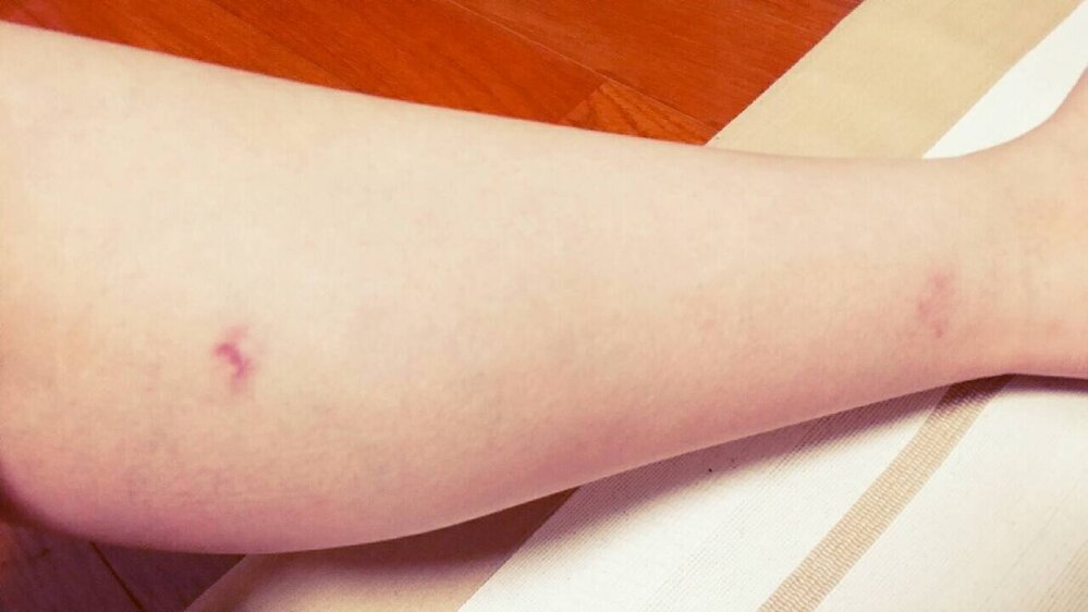ふくらはぎに 覚えのない内出血が出来てます 押さえても痛みはありません Yahoo 知恵袋