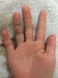 昨日突き指をして気づいたらこんな感じでした 曲げると第二 Yahoo 知恵袋