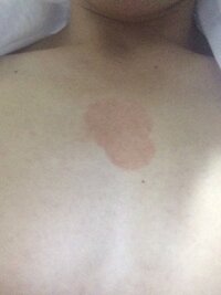 二年前ぐらいから胸の真ん中らへんにこの赤いあざみたいなのがある Yahoo 知恵袋