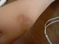 友達の犬に噛まれてアザになっています 病院には行ってないです Yahoo 知恵袋