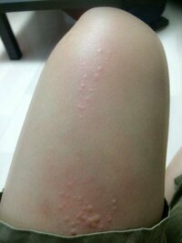 飼っているハリネズミを誤って足の上に落としてしまい 針がちょっとチクっと刺さったところが写真のようになりました。(水ぶくれとかではなくたくさん蚊に刺された感じ。) 少しチクチクと痒みがあります。
しばらくしたら治りますか？
