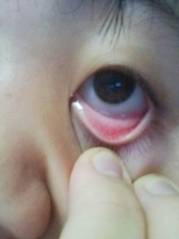 下 まぶた 貧血 貧血で目の下のまぶたの裏が白くなる理由