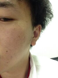 20代 男です 顔がニキビだらけ それともニキビ跡 かはわかりませんが Yahoo 知恵袋