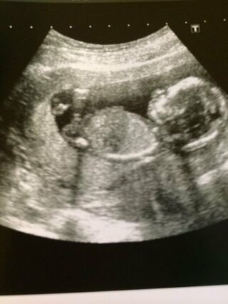 妊娠14週のエコー写真です 横向きなので分かりにくいと思いますが Yahoo 知恵袋