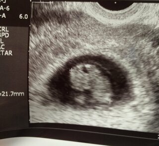 現在妊娠９週３日です 昨日のエコー写真なのですが 胎児の背部にあるものは Yahoo 知恵袋