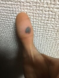 血豆が1ヶ月以上治らなくて困っています 指をペンチで挟ん Yahoo 知恵袋