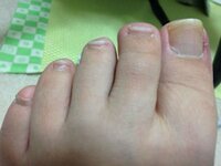 足の爪の形について 足の小指の爪の形がすごく反っています写真は爪を横か Yahoo 知恵袋