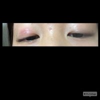 アイプチ負け 画像あり目の腫れについて下を向いた写真があるので 腫れて Yahoo 知恵袋