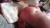 赤ちゃんの皮膚の薬ただれについて回答お願いいたします 湿疹が出 Yahoo 知恵袋