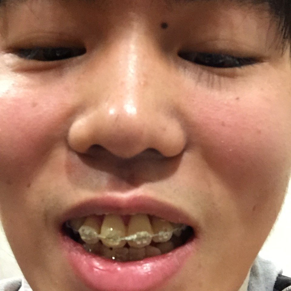 画像あり僕はいま18歳で歯の矯正7ヶ月目ですいま前歯と二番の歯にパワーチ Yahoo 知恵袋
