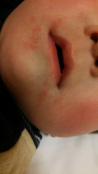 食物アレルギー 9ヶ月の娘の発疹について質問させてください 本日 Yahoo 知恵袋