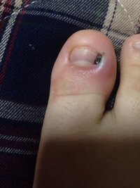 画像あり 汚いです 爪周囲炎だと思うのですが 現在 肉芽をネッ Yahoo 知恵袋