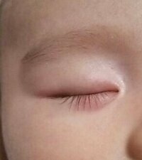 ６ヶ月の赤ちゃんの目の周りに湿疹 がでました 朝からなんとなくうっ Yahoo 知恵袋
