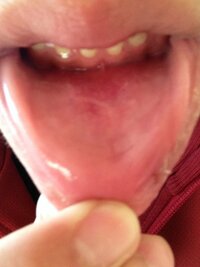 下唇の裏に白い線が出来ていましたものすごく痛くて 腫れています表には赤い Yahoo 知恵袋