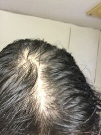 抜け毛が酷いです 毎日というか 常時抜けてる感じです 手 Yahoo 知恵袋