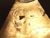 胎児のエコーでの性別 24週の妊婦健診で 子宮が見えたので女の子と言 Yahoo 知恵袋