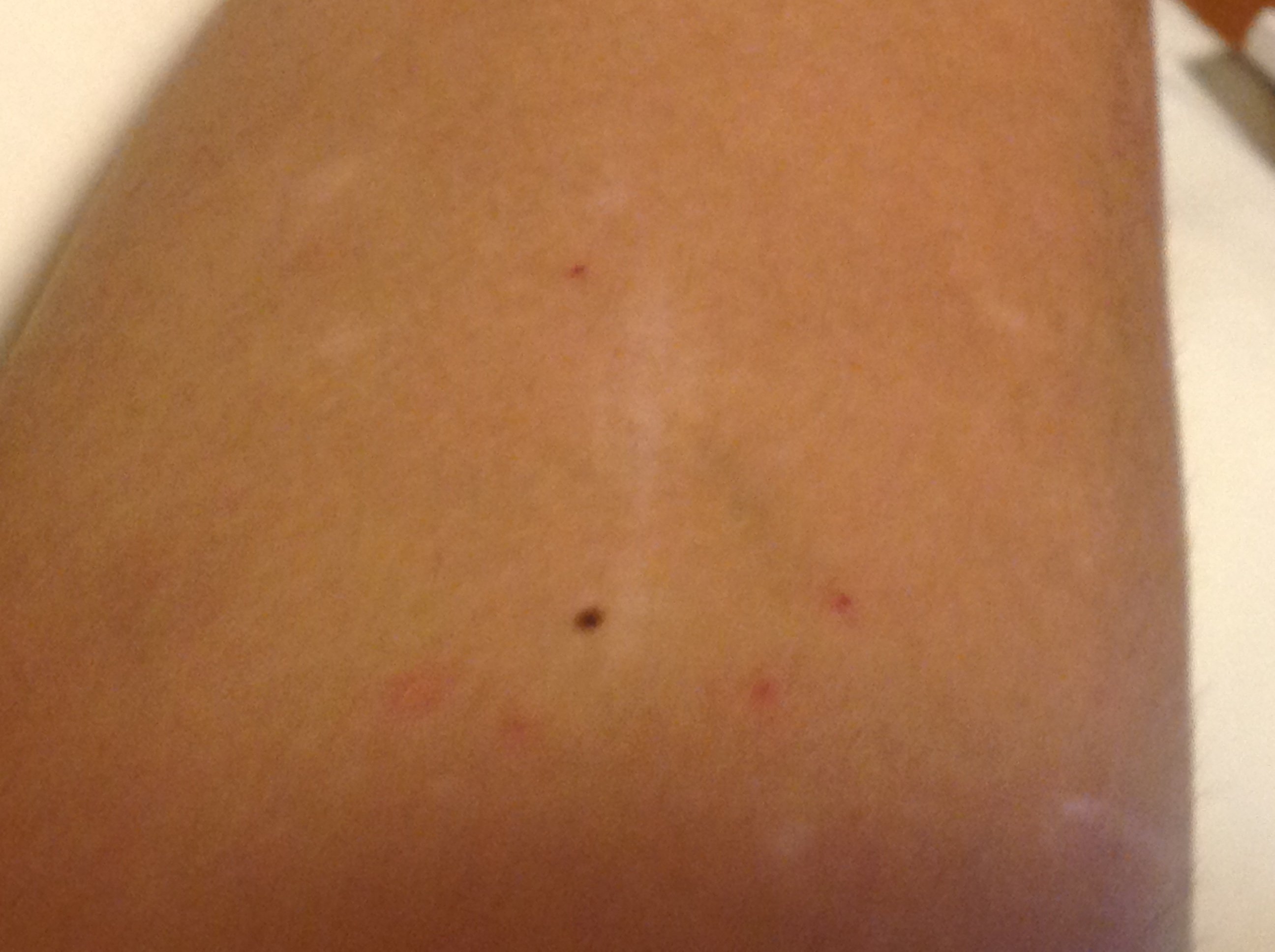 これはダニ刺されでしょうか 画像あり いつもこんなかんじの赤い点が Yahoo 知恵袋