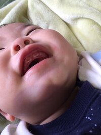 子供の奥歯の生え始めの部分に赤い血 虫歯 １歳３ヶ月 奥歯が生え始め Yahoo 知恵袋