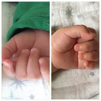 生後8ヶ月の赤ちゃんの爪が深爪になります。 壁や絨毯など、手に触れるものをガリガリやるのが好きなようです。
指しゃぶりで柔らかくなった時にガリガリやるので割れて深爪になっていたりします。
白い部分は残して切るのですが、爪が反り、どんどんピンクの部分が減って痛そうです。

そのうち治るでしょうか？
赤ちゃんではよくあることなのでしょうか？
また、爪を切る時はガリガリした時に引っかかる部分を少な...