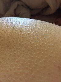 お尻の毛穴がかなりひどいです どうしたら改善しますか 2 Yahoo 知恵袋