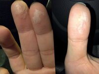 指の皮膚について 先週から指先が硬くなり ひびわれはじめました Yahoo 知恵袋