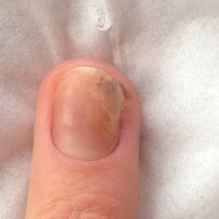 これはメラノーマですか できたのは約3ヶ月前です 朝起きたら中 Yahoo 知恵袋