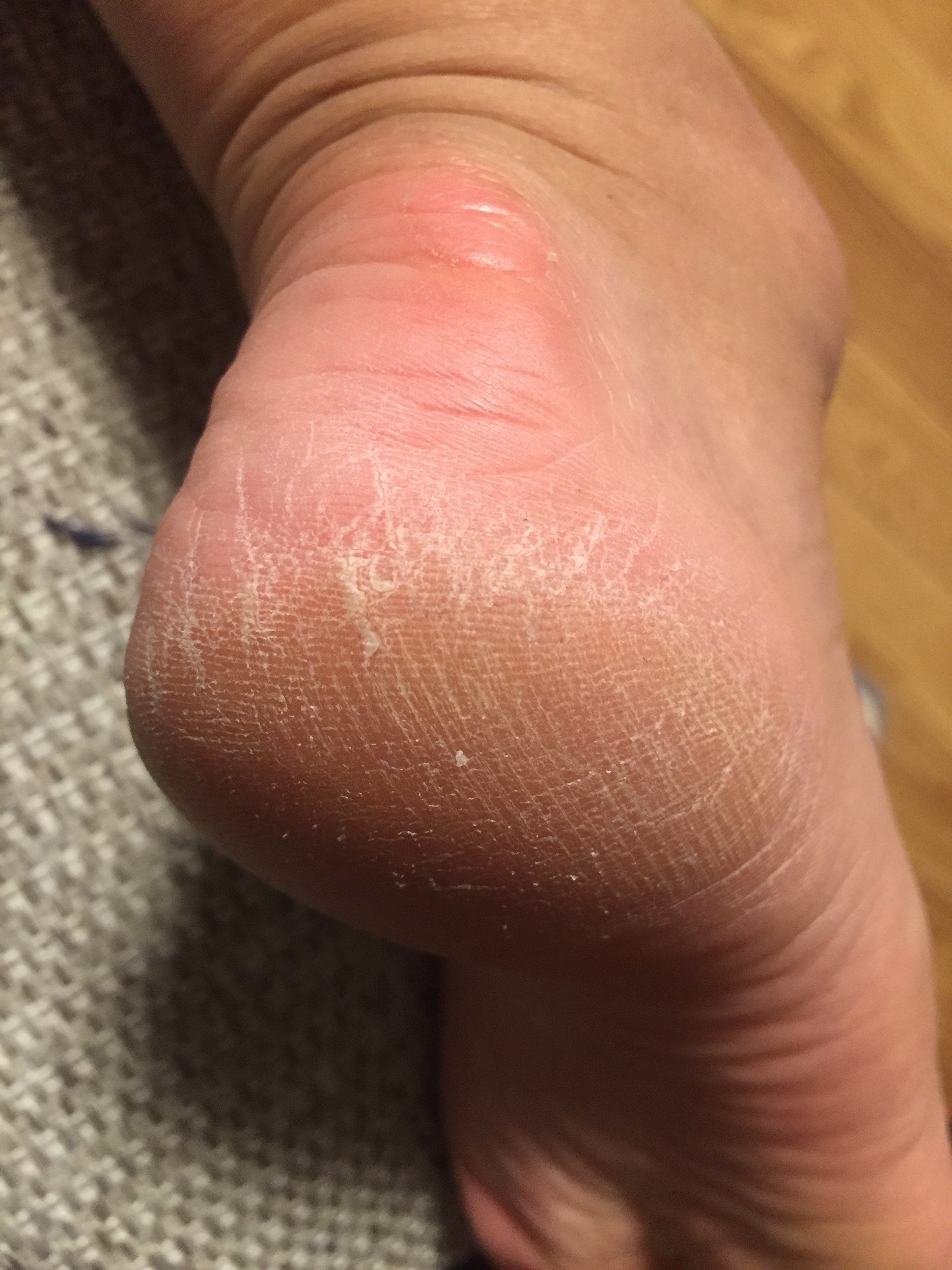 かかと 水虫 乾燥 見分け 方