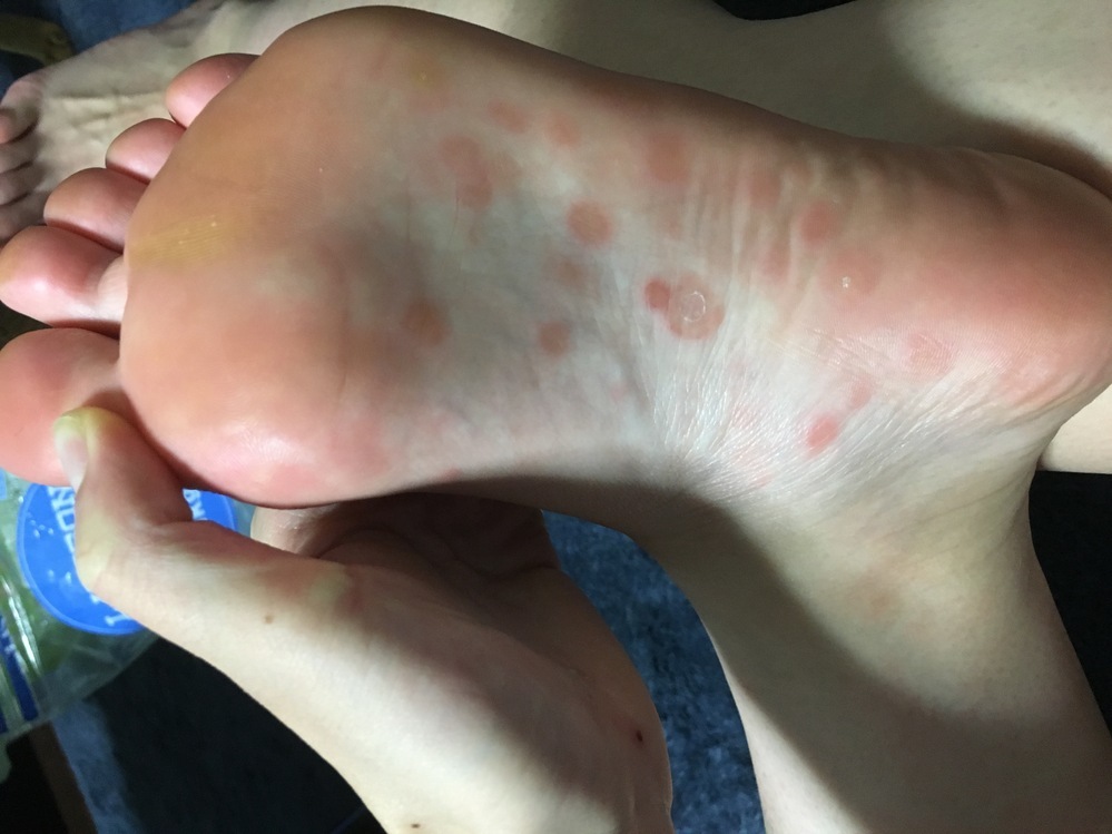 足の裏に赤い斑点がたくさん出来ました。 ダニやノミに刺されたのでしょうか？ 痒みは少し痒い程度です。