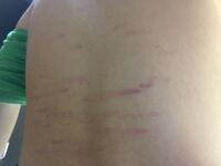 背中に肉割れができてしまってます 肉割れはどうすれば薄くす Yahoo 知恵袋