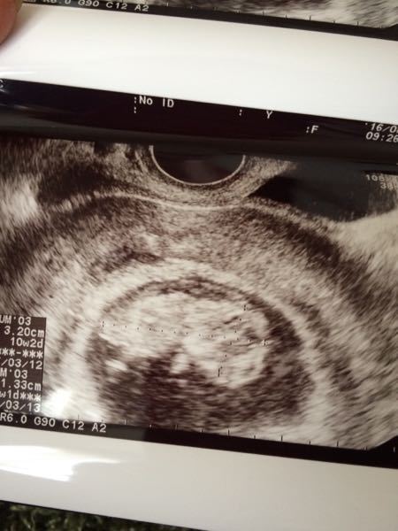 27歳 10週目です エコー写真が少し気になり 投稿して Yahoo 知恵袋