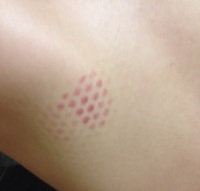 詳しい方教えて下さい 彼の背中にきれいな斑点模様のアザ ができ Yahoo 知恵袋