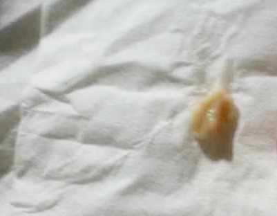 痰が喉にへばりつくので悩んでいます この喉に痰がへばりつく症状は病気でし Yahoo 知恵袋