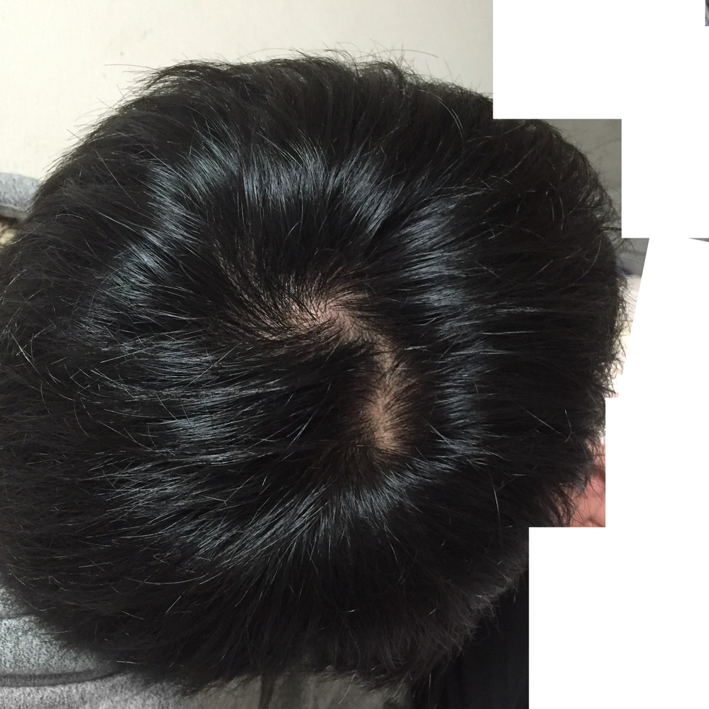 薄毛 抜け毛 解決済みの質問 Yahoo 知恵袋