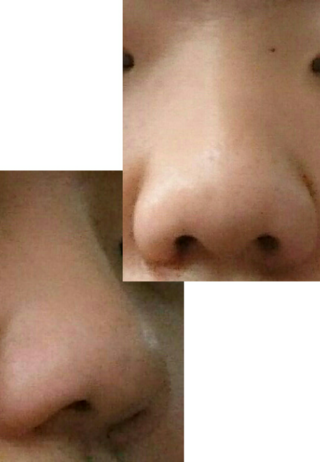 100以上 豚鼻 治った 数年で最も興味深い壁紙壁紙新日本a