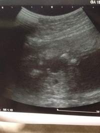 現在2人目を妊娠中で18wです 本日エコーで突起物が見え はっ Yahoo 知恵袋