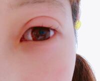 アレルギー 目 の 腫れ