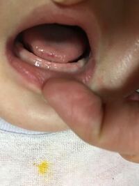 赤ちゃんが口内炎 生後2カ月の赤ちゃんの歯茎に 1ミリ程の口内炎の Yahoo 知恵袋