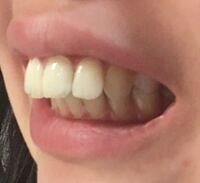 1度歯列矯正をしていたのですが もう一度やりたいです 前回のは抜歯 Yahoo 知恵袋