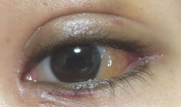 結膜浮腫について写真ありです 一週間ほど前に目の整形手術を Yahoo 知恵袋