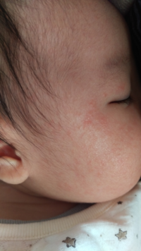 乳児湿疹かアレルギーか生後1ヶ月の赤ちゃんがいます 母乳 Yahoo 知恵袋
