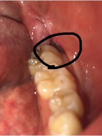 親知らず抜歯後の質問です 一週間前に右下親知らずを抜歯しました 歯は歯 Yahoo 知恵袋