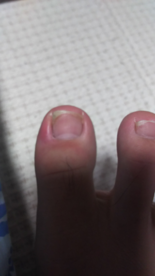 が 腫れる の 親指 足